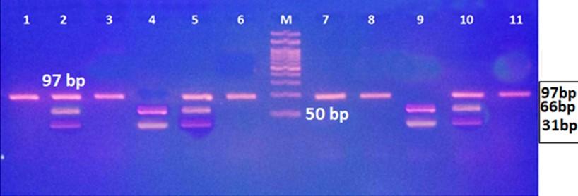 Granzyme B gene polymorphisms and risk of hepatocellular carcinoma in patients with chronic hepatitis