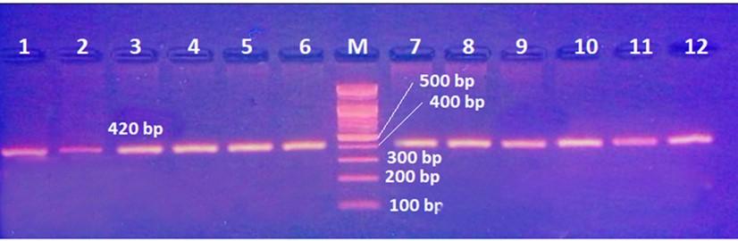 Granzyme B gene polymorphisms and risk of hepatocellular carcinoma in patients with chronic hepatitis