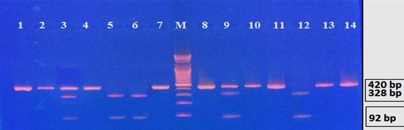 Granzyme B gene polymorphisms and risk of hepatocellular carcinoma in patients with chronic hepatitis