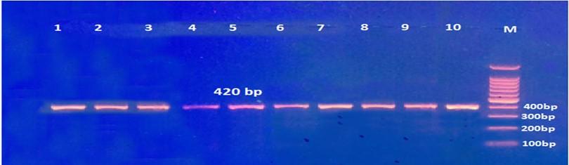 Granzyme B gene polymorphisms and risk of hepatocellular carcinoma in patients with chronic hepatitis