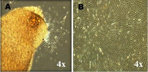 Characterization of human articular cartilage derived mesenchymal progenitor cells from osteoarthritis patients
