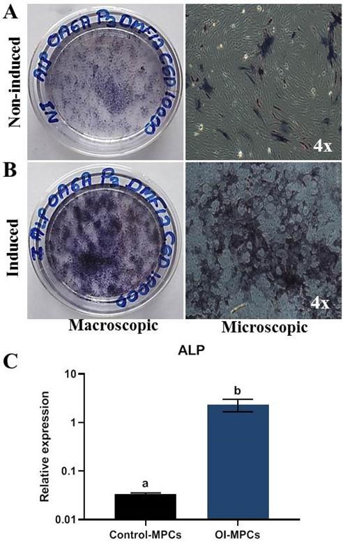 Characterization of human articular cartilage derived mesenchymal progenitor cells from osteoarthritis patients