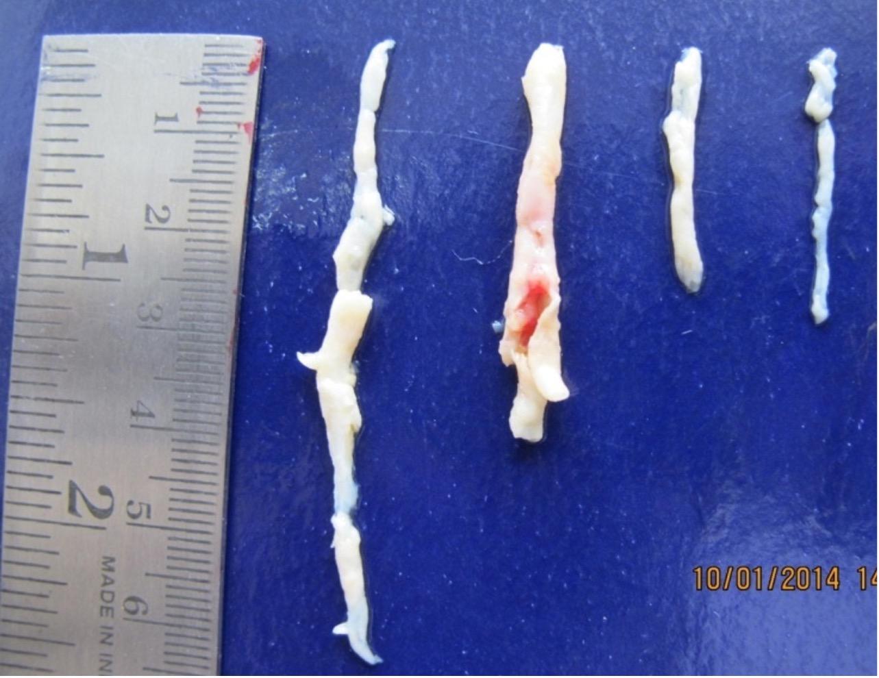 Analysis of telomere length in the coronary artery to determine the pathogenesis of coronary artery disease