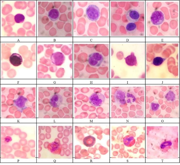 Hematological leukocytes ratio indices: predictors of acute purulent fecal peritonitis in nonlinear laboratory rats