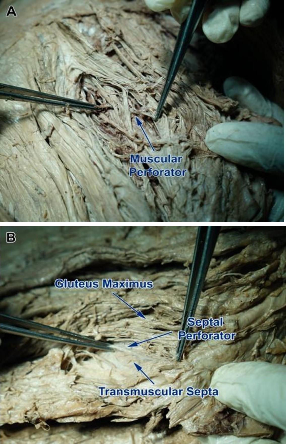 Identifying and locating superior gluteal artery perforator on Vietnamese adults – A study for clinical applications