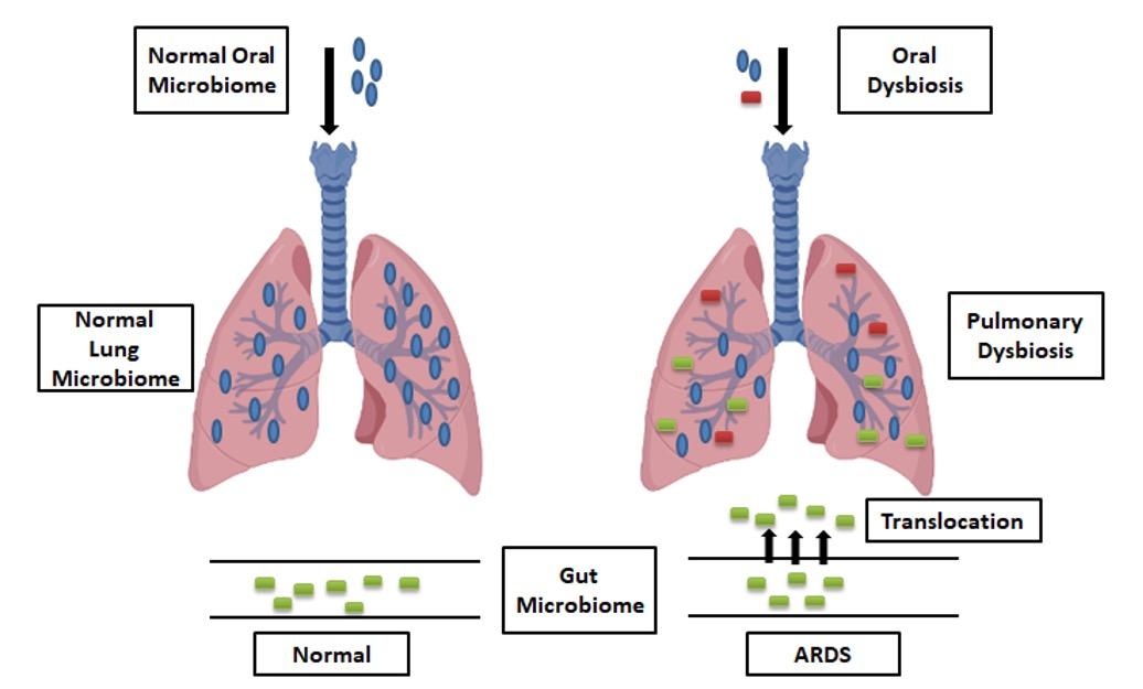 Association of gut microbiota in the pathogenesis of acute respiratory distress syndrome and possible pharmacotherapy by sphingosine-1-phosphate
