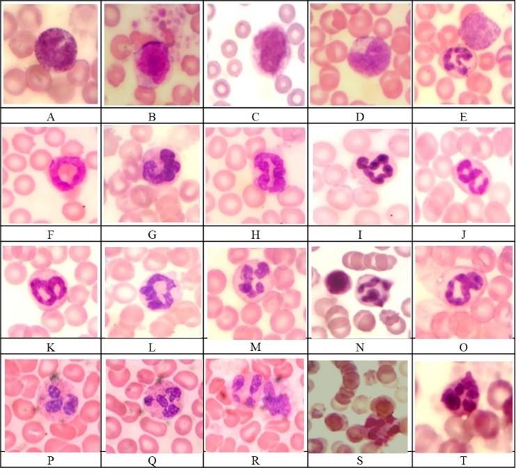 Hematological leukocytes ratio indices: predictors of acute purulent fecal peritonitis in nonlinear laboratory rats