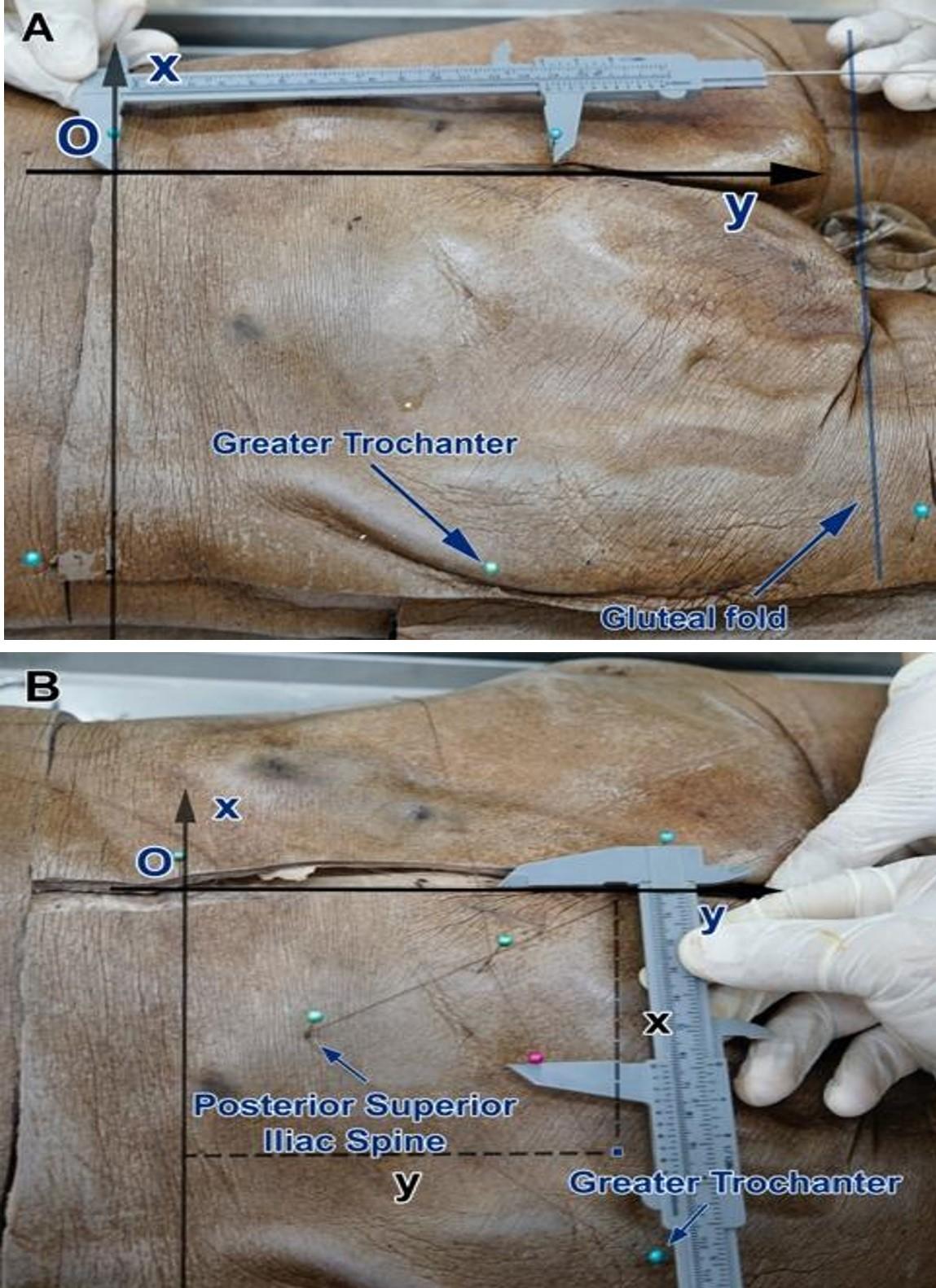 Identifying and locating superior gluteal artery perforator on Vietnamese adults – A study for clinical applications
